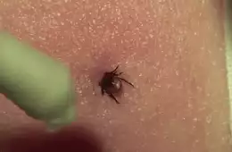 How To Remove A Tick With A Cotton Swab Video Featured